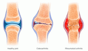 natural arthritis pain cream